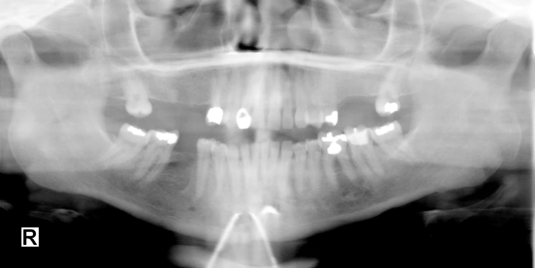 Digital Dental X-Rays Stonecrest — digital x-rays for children at Lithonia Pediatric Dentistry, Stonecrest, GA